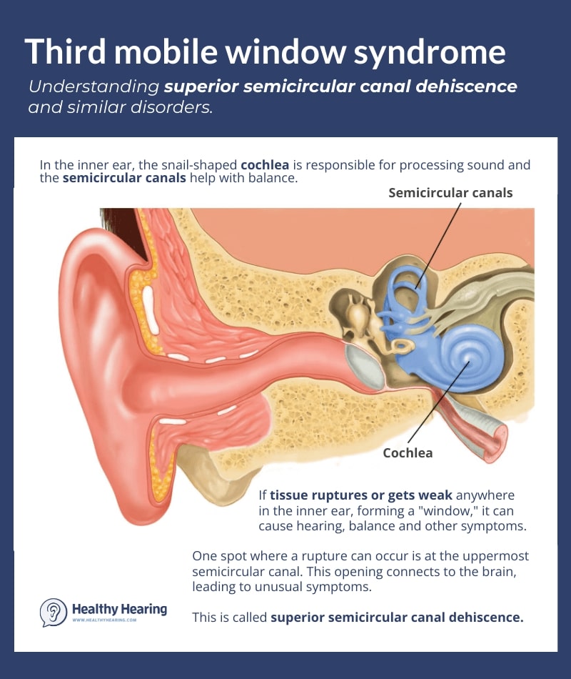 A diagram of the inner ear explaining third mobile window syndromes like superior semicircular canal dehiscence.