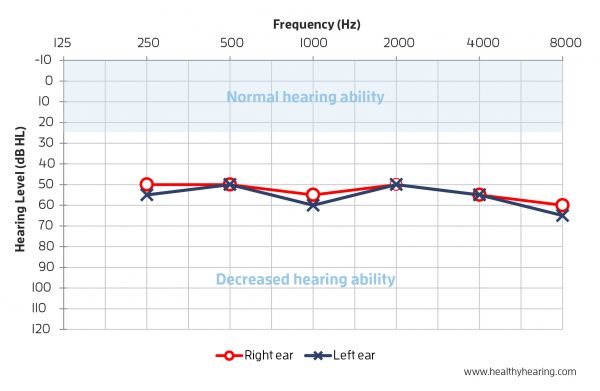 An audiogram is displayed with left and right ears plotted