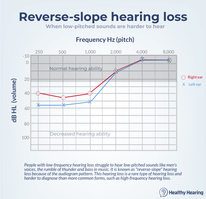 Audiogram depicting reverse slope or low-frequency hearing loss