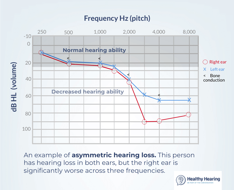 An audiogram showing asymmetrical hearing loss, worse in the right war. 