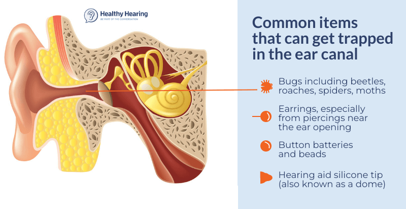 Infographic explaining the most common items that can get stuck in the ear, including bugs, batteries, beads, hearing aid domes/tips, and more.