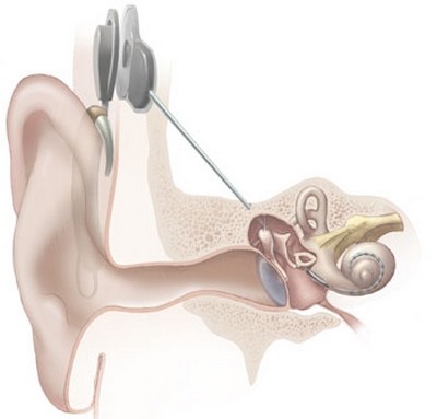 Cochlear implant diagram