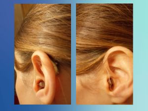 CROS hearing aids as seen on a woman.
