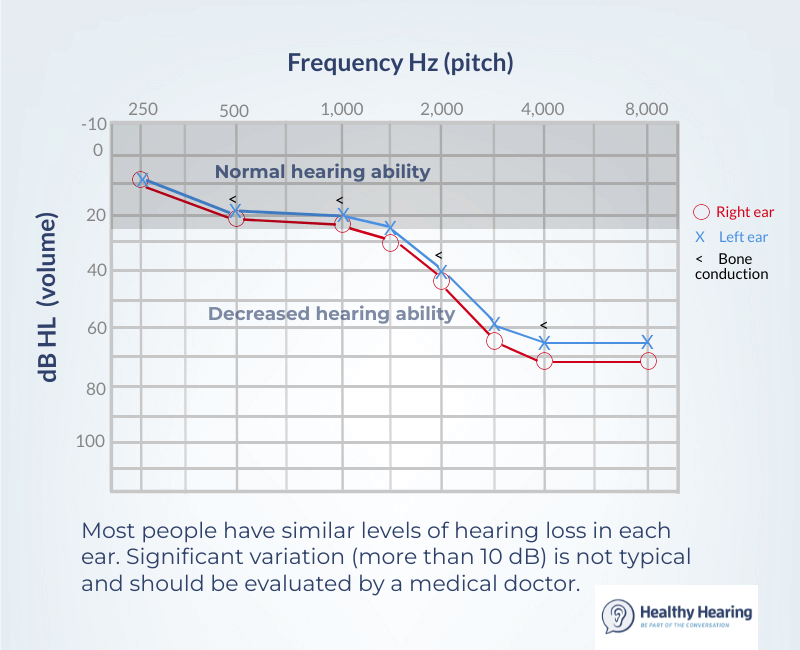 An audiogram showing an example of normal hearing between both ears. 