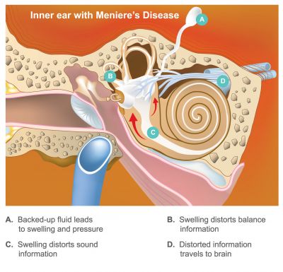 Graphic showing inner ear during Meniere's