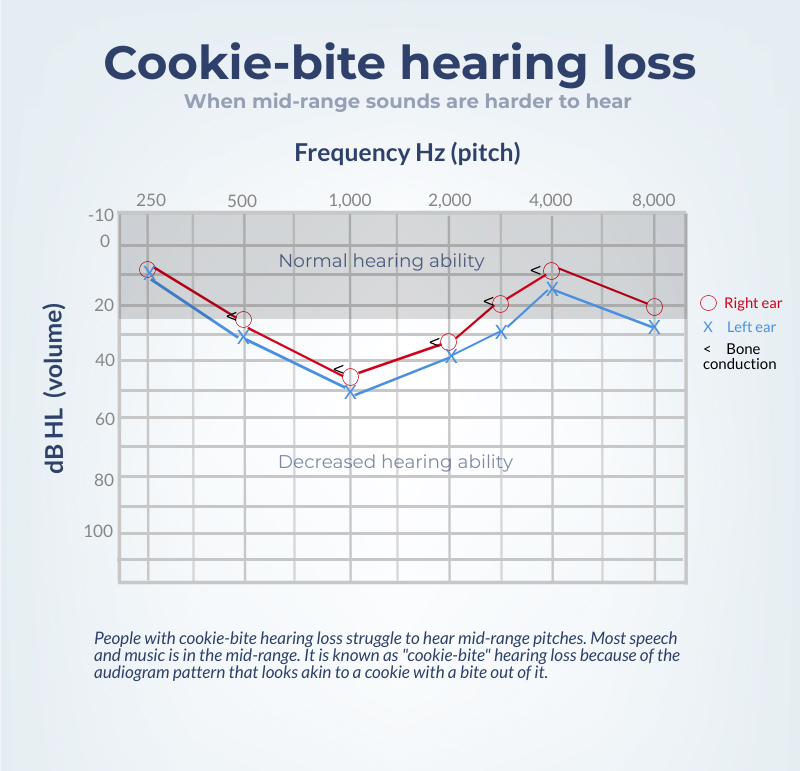 Audiogram showing what cookie-bite hearing loss looks like.